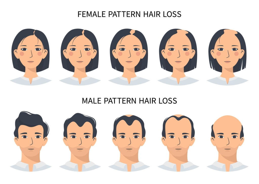 Understanding the Different Types of Baldness