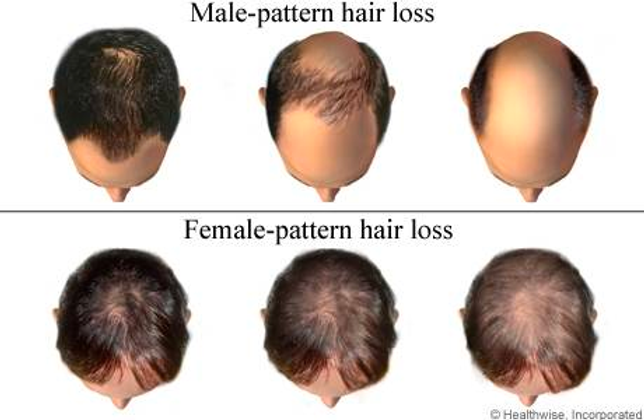 Male vs Female Baldness – Key Differences