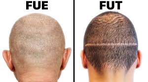 FUT vs FUE Hair Transplant: Which Procedure is Right for You?